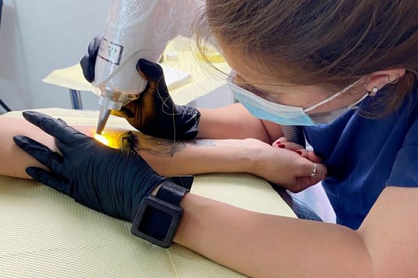 Eliminación de tatuajes en Valencia