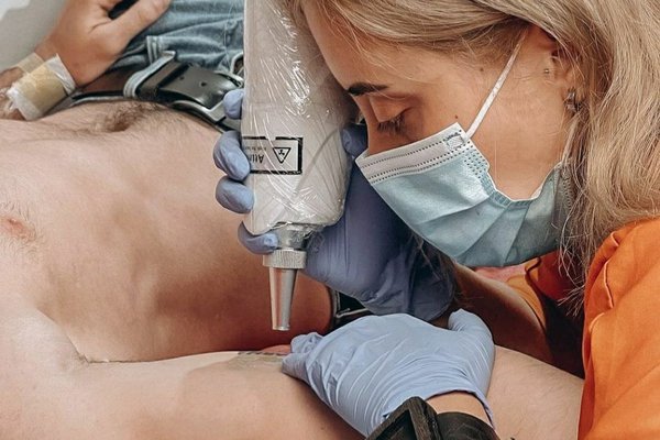 Eliminación de tatuajes en Valencia